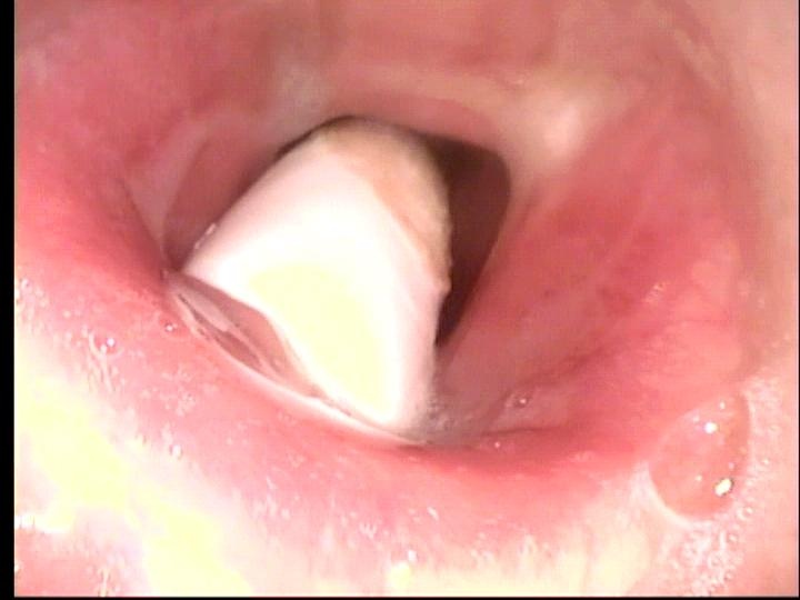 Barrel of #8 cuffless Shiley trach partially occluding airway