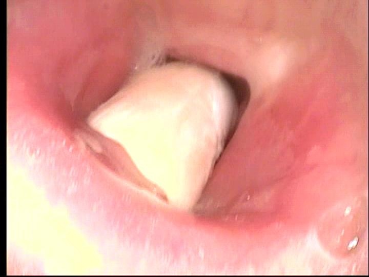 View of tracheotomy tube partially occluding tracheal airway