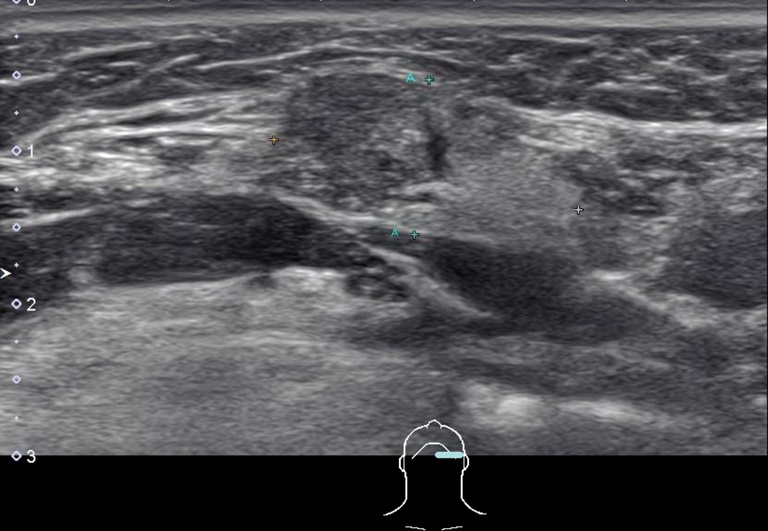 Preoperative ultrasound: 