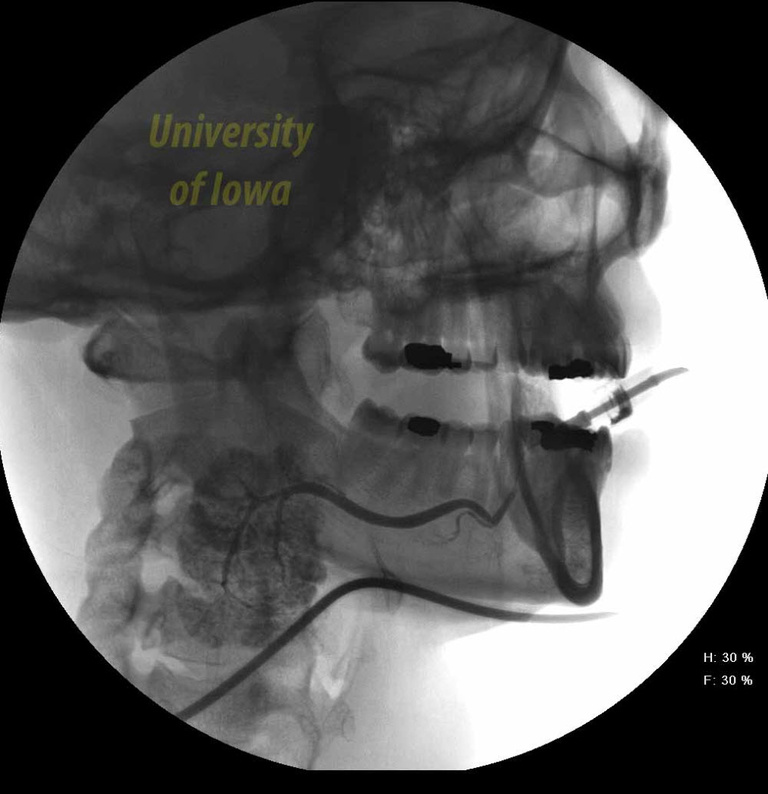 Normal submandibular sialogram with Bartholin's duct