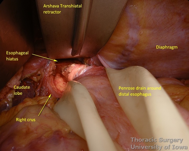 Arshava illuminated transhiatal retractor is used to facilitate exposure for mediastinal dissection esophagectomy