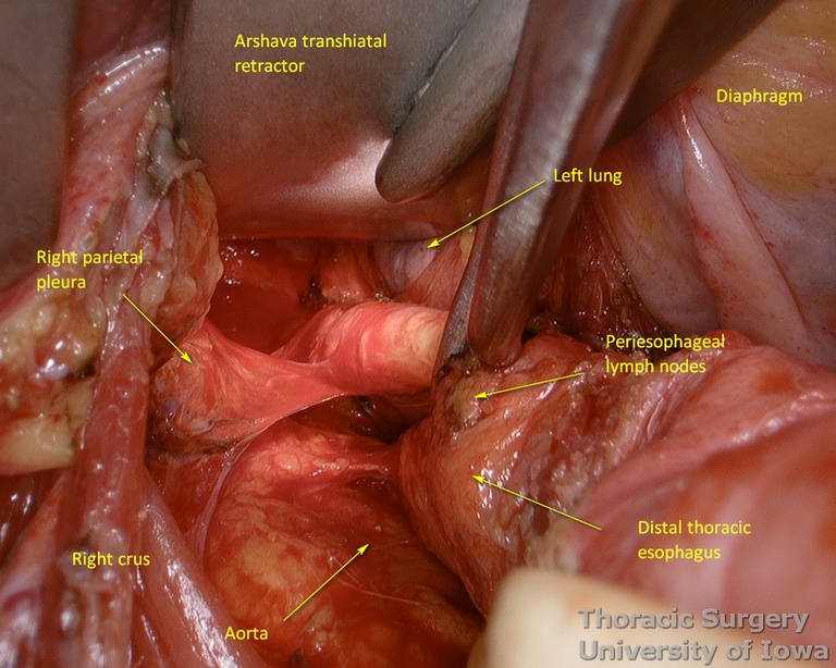Arshava transhiatal retractor for mediastinal dissection during esophagectomy with right lateral esophageal attachments exposed