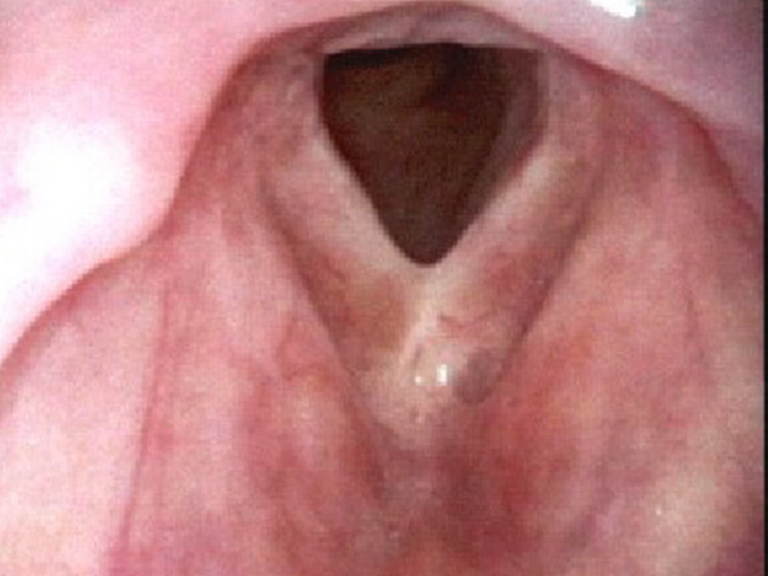 January 2017 sialography with balloon dilation under fluoroscopy left parotid