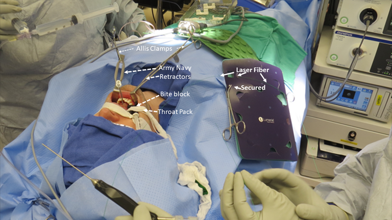 January 2017 ultrasound done immediately after fluoscopic balloon dilation