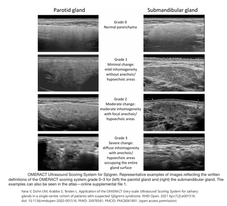 Omeract Grades 0,1,2,3 for Sjogrens