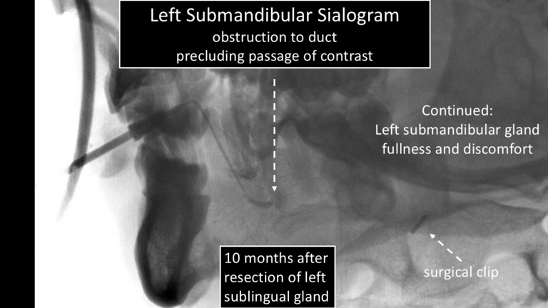 sialogram showing obstruction