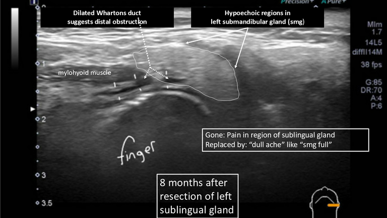 ultrasound sublingual gland stone dilated duct