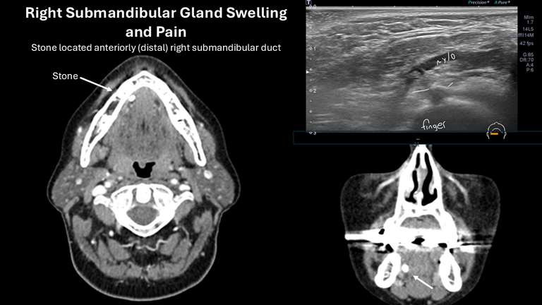 open ductoplasty for submandibular stone