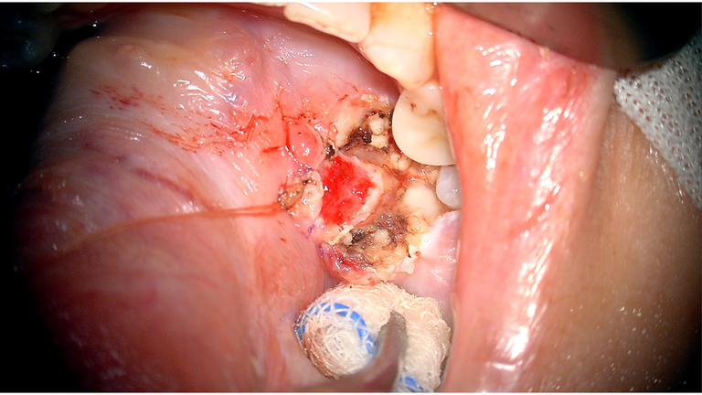 open ductoplasty for submandibular stone