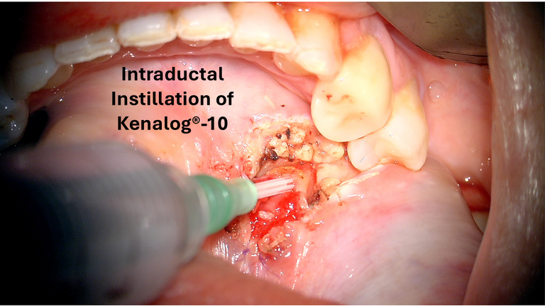 open ductoplasty for submandibular stone