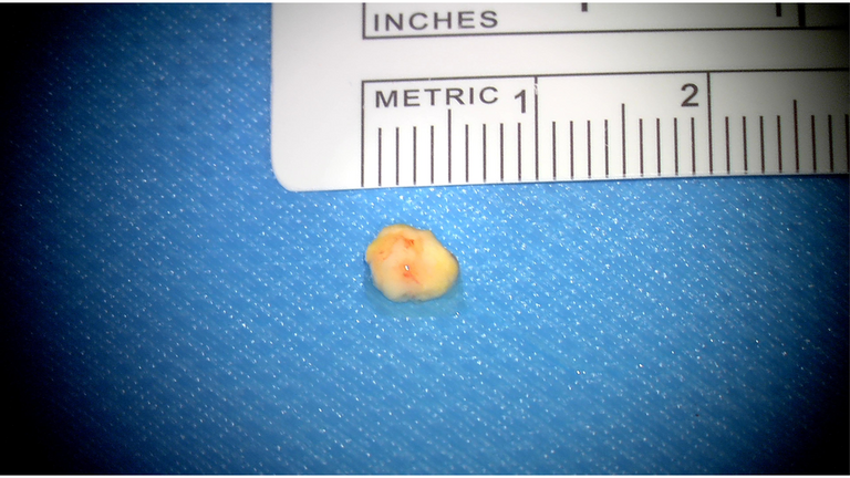 open ductoplasty for submandibular stone