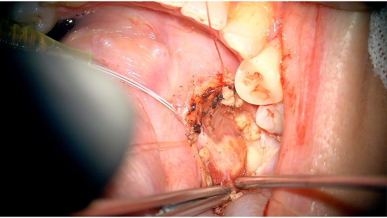 open ductoplasty for submandibular stone