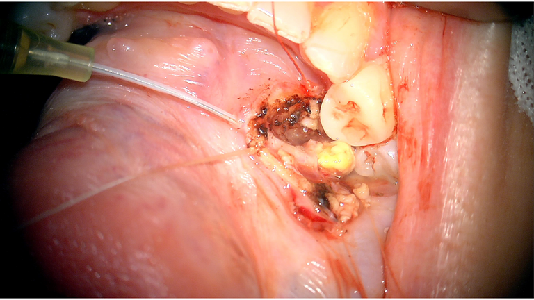 open ductoplasty for submandibular stone