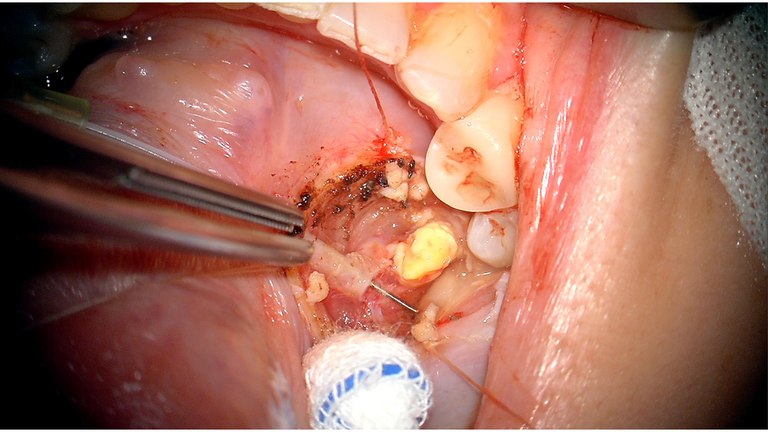 open ductoplasty for submandibular stone