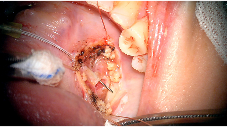 open ductoplasty for submandibular stone