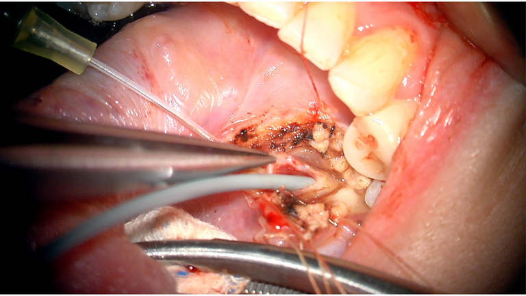 open ductoplasty for submandibular stone