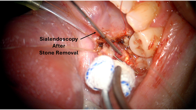open ductoplasty for submandibular stone