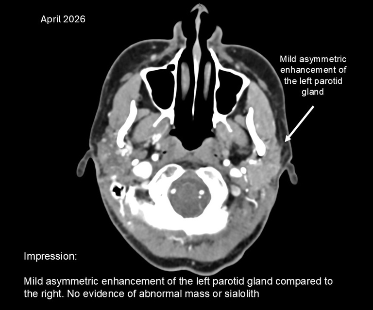 CT 3 yrs after facelift with fistula