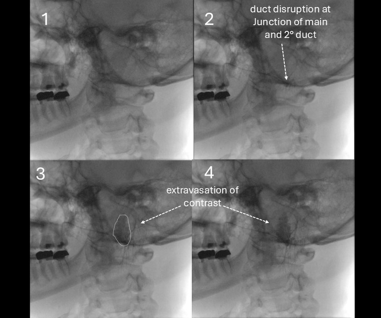 sialogram sequence identifying extravasation at duct injury