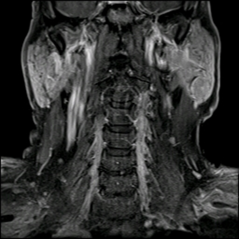 003%20mri%20tail%20parotid.jpg