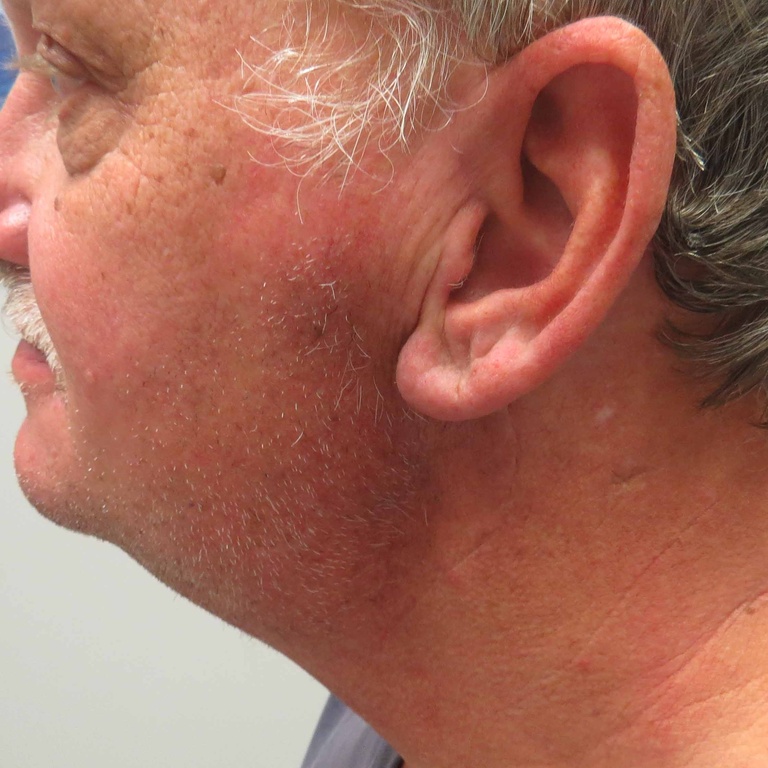 4 1/2 months after parotidectomy