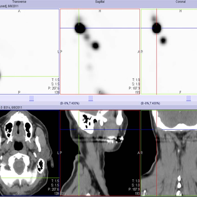 Lymphoscintigram with CT co-registration. Note the post-auricular/anterior occipital node identified within the cross-hairs on the three CT images