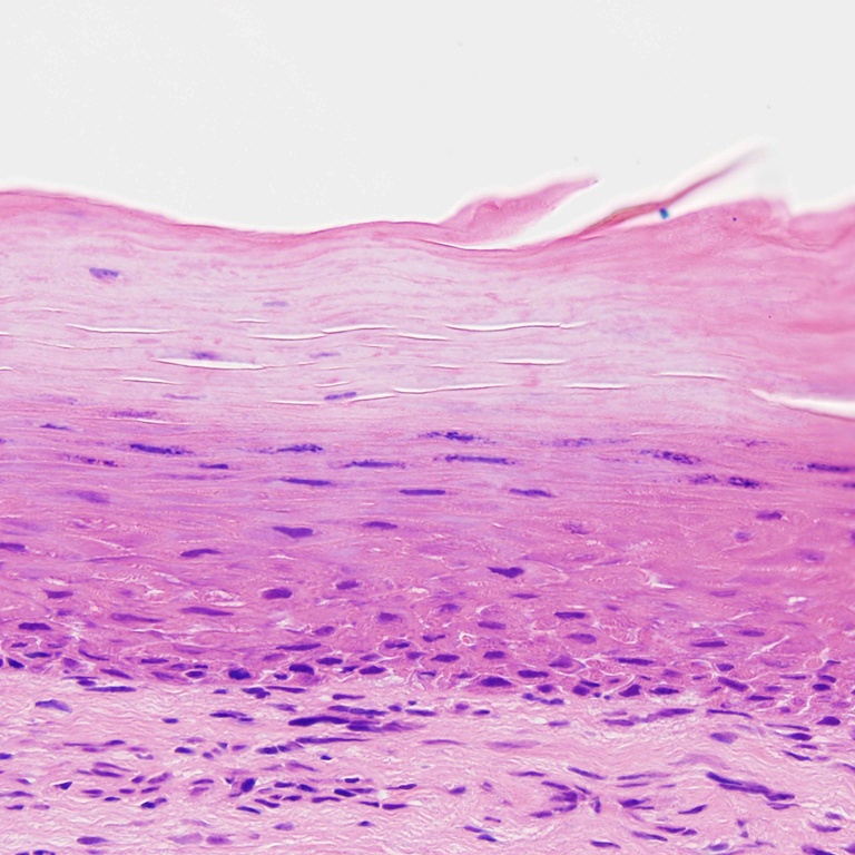 In contrast to the prior photomicrograph, this portion of the mucosa shows a densely keratotic surface without significant cytologic atypia and a regular mucosal/submucosal junction.