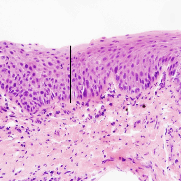 This biopsy is interesting because is shows a transition of carcinoma in situ (left of black line) to a lower degree of dysplasia (right of black line). On the left, there is architectural disorder, more nuclear hyperchromatism, and basal layer expansion.