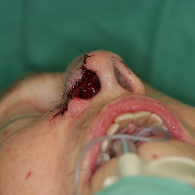 1st Stage Intraop-Forehead flap inset-Basal view 