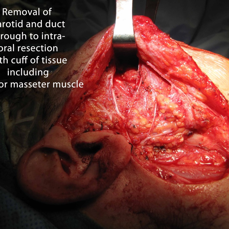 026 parotid 092009.jpg