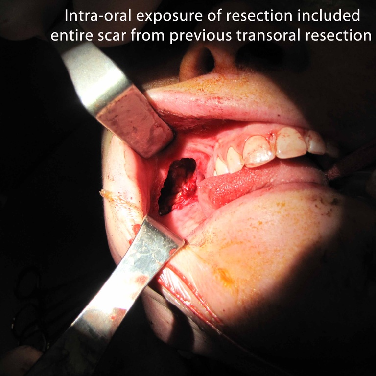 030 parotid 092009.jpg
