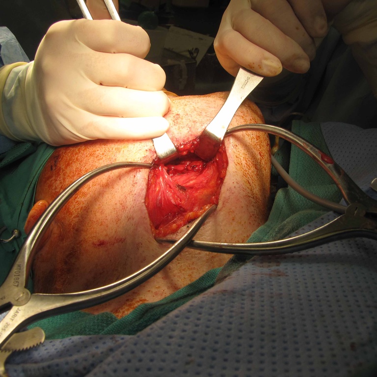d. Appearance of wound after gland and stone removal