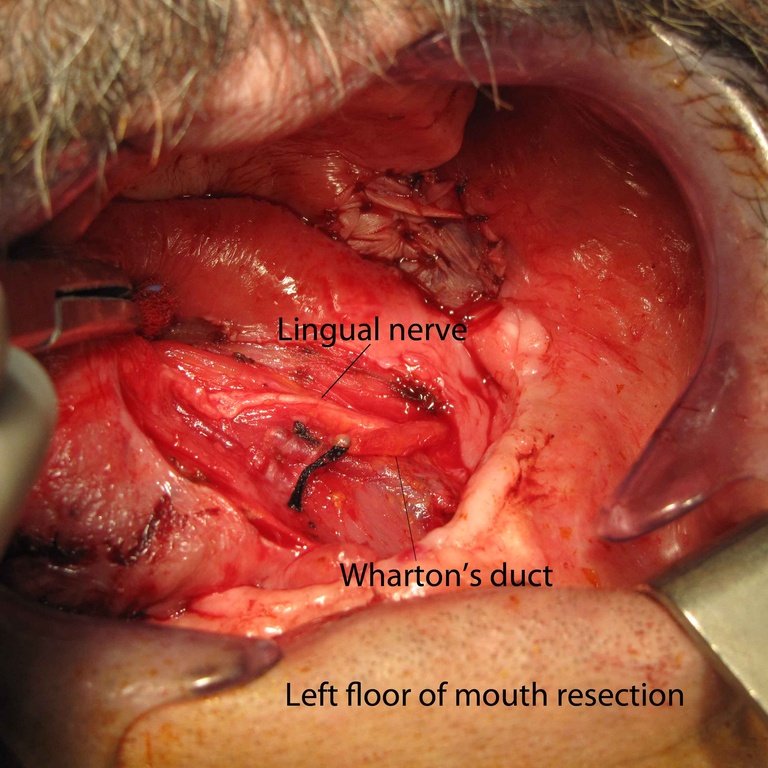 03ductoplasty%20c.jpg