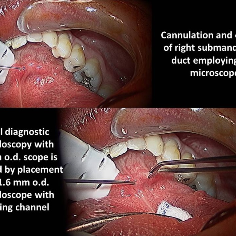 042%20foreing%20body%20sialendoscopy.jpg