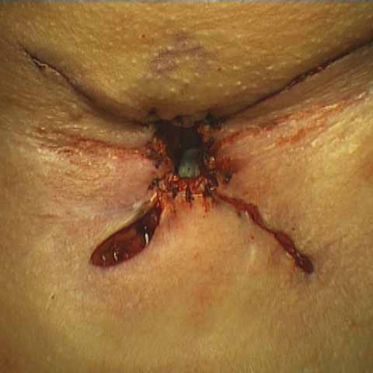 042%20trachstenosis.jpg