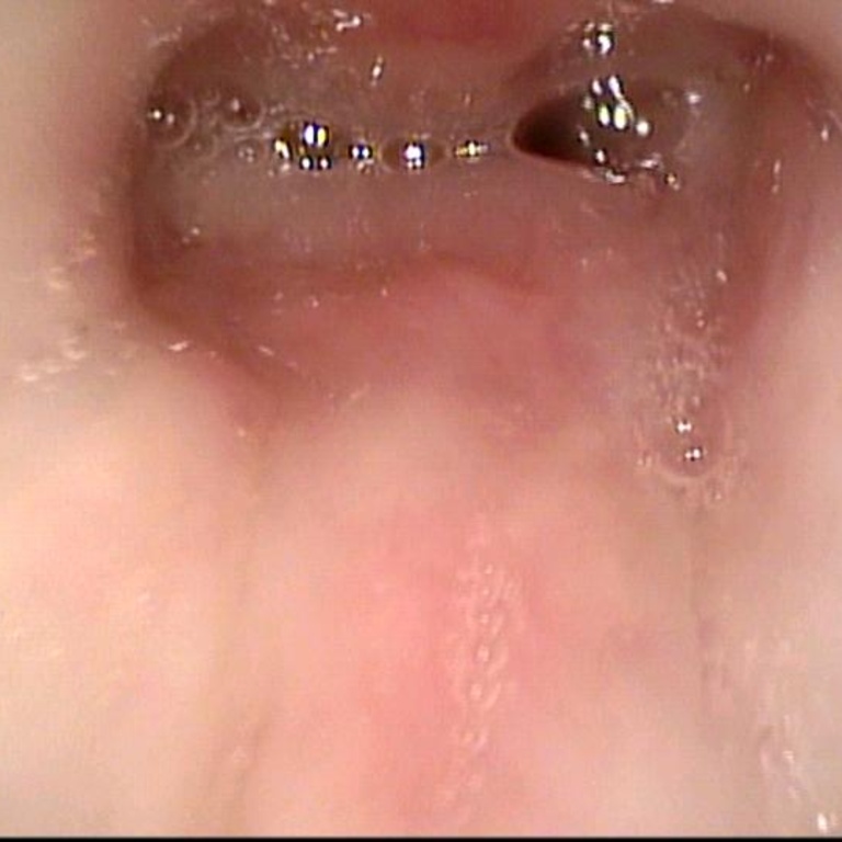 10-21-10 transnasal fiberoptic view between the vocal cords of subglottis