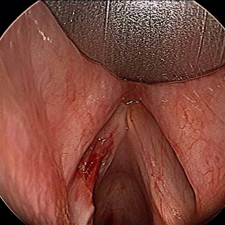 Intraoperative - resection of left vocal fold leukoplakia