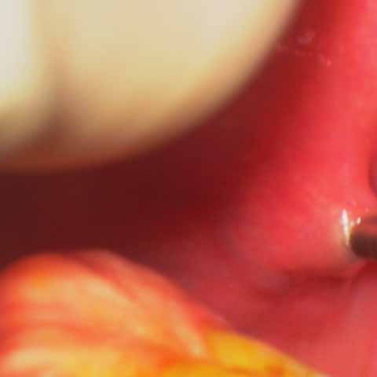 dilation of left parotid duct over 0.018 in microangio guide wire
