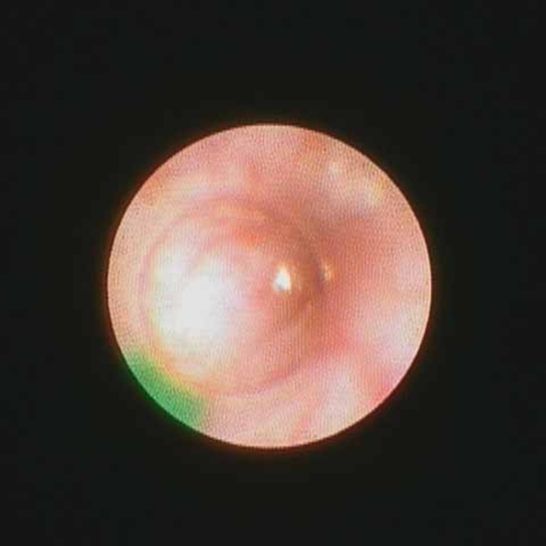 clear lumen confirmed with sialendoscope at end of case through stent prior to kenalog placement