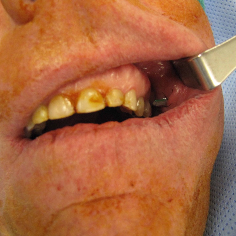 view of stent at end of case
