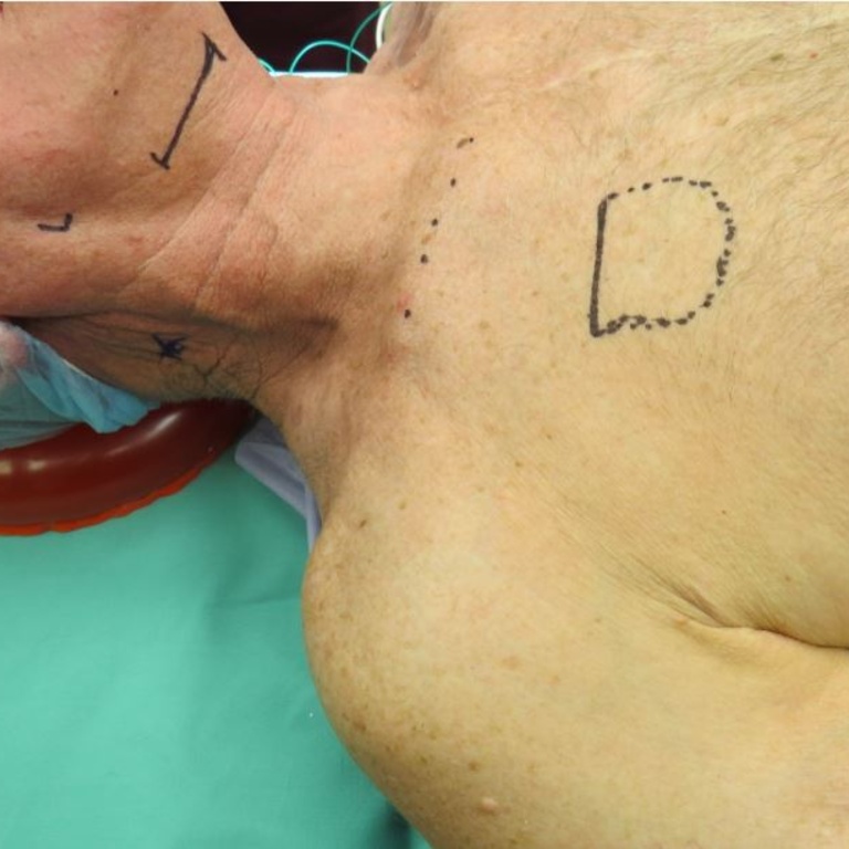 Figure 6. Incision placement (1) midway between hyoid bone and mandible (2) 3 cm inferior to clavicle