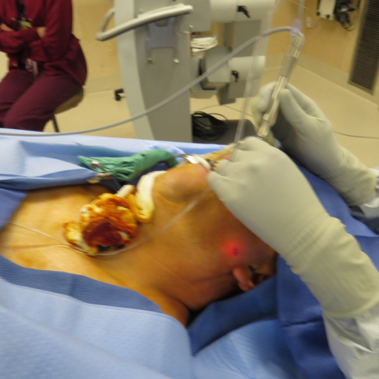 laser sialendoscopy for parotid stone