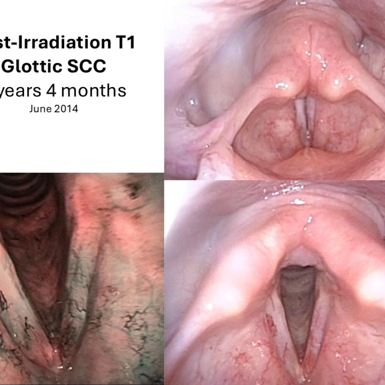 T1 post XRT long term sequence