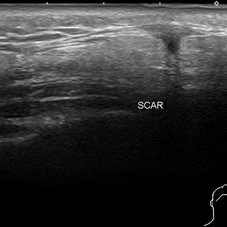Lymphadenoma parotid