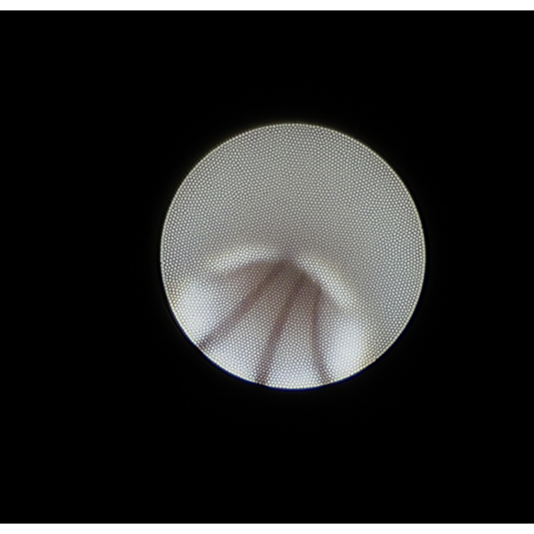 laser sialendoscopy for parotid stone