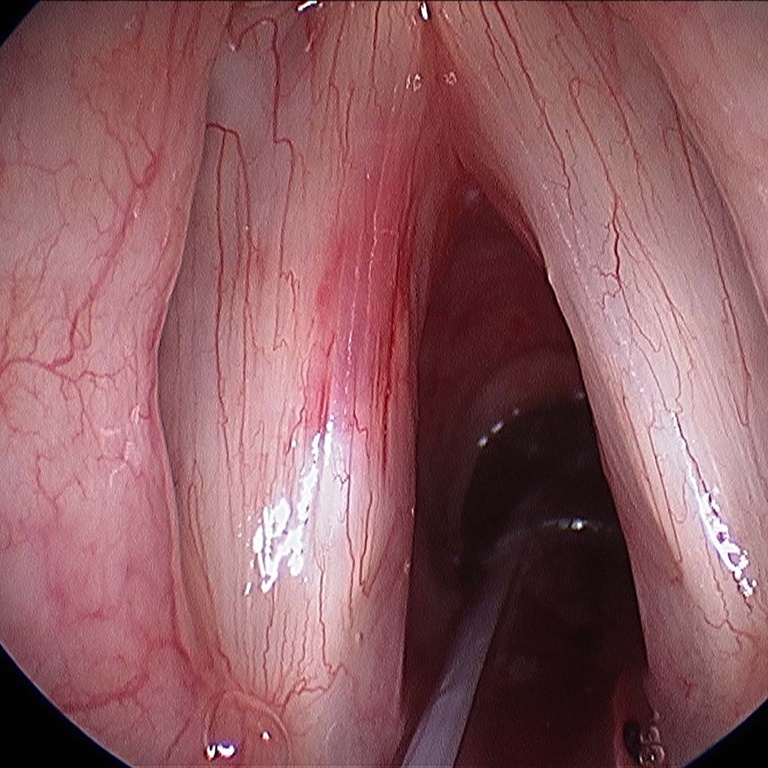 after cyst excision.jpg