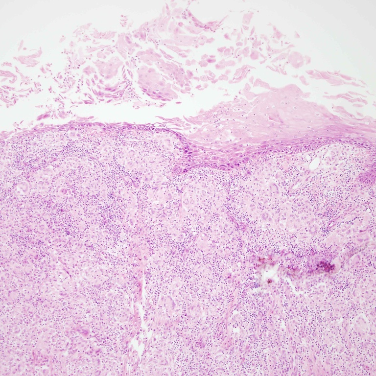 This biopsy shows a keratotic surface crust with a vaguely nodular submucosa expansion at low power. In this case, the abnormality appears to be going from the bottom up, rather than the top down, as is often observed with neoplasia.