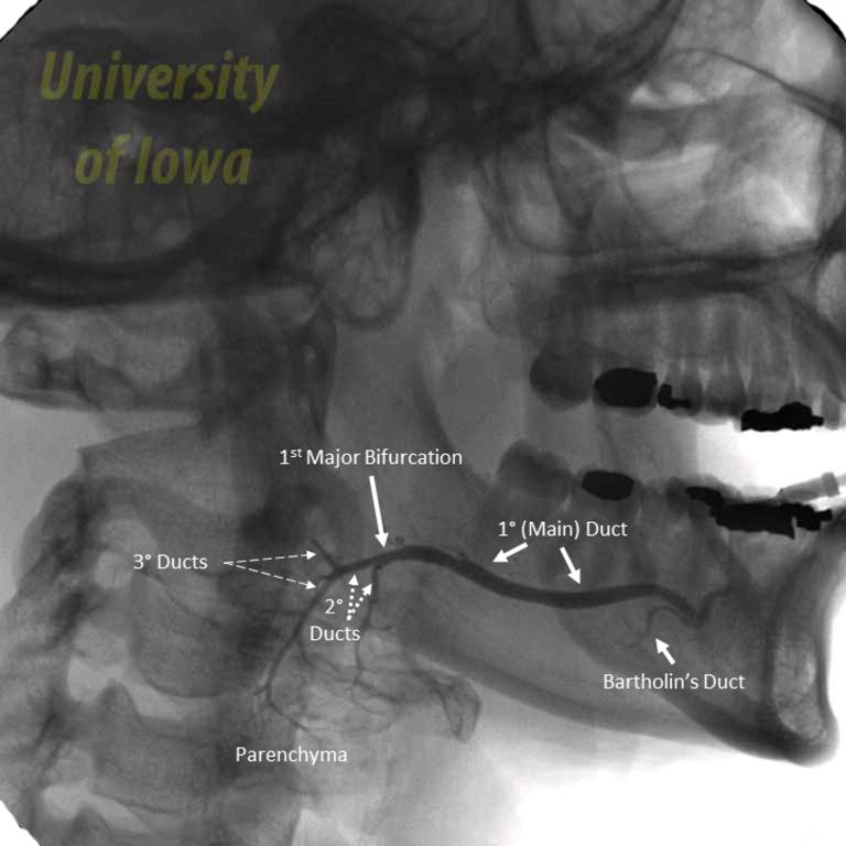 submandibular duct classification 01 03 2020.png