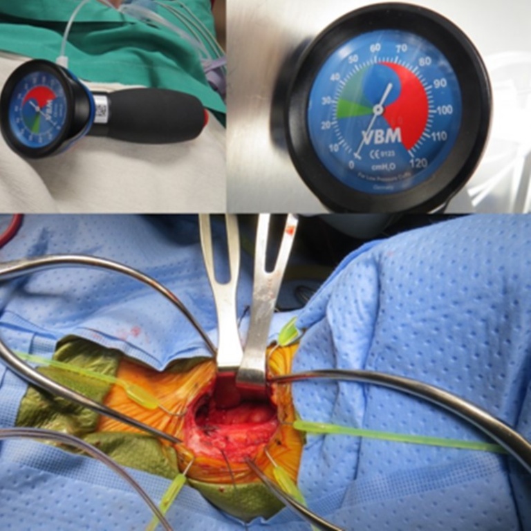 exposure-for-cervical-spine-surgery